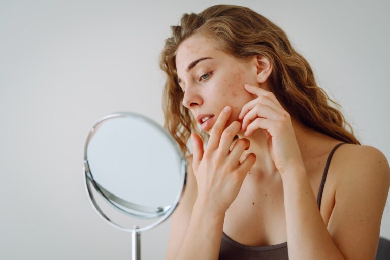 10 Weetjes over acne: Wat je nog niet wist over puistjes