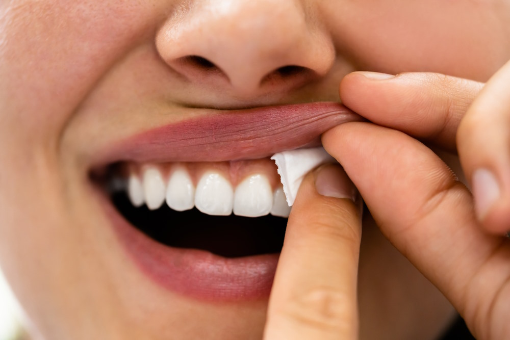 snus bovenlip